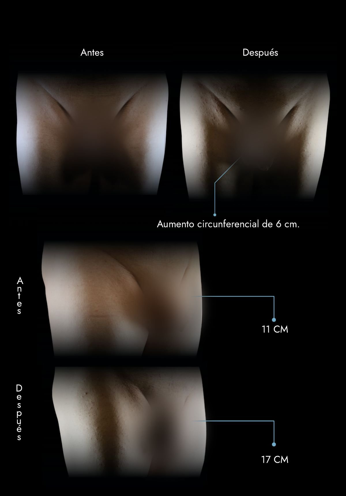 Faloplastia de engrosamiento con injerto de grasa autóloga: aumento circunferencial de 6 cm (de 11 cm a 17 cm), antes y después, caso real del Dr. Daniel Ramos, cirujano plástico en Bogotá