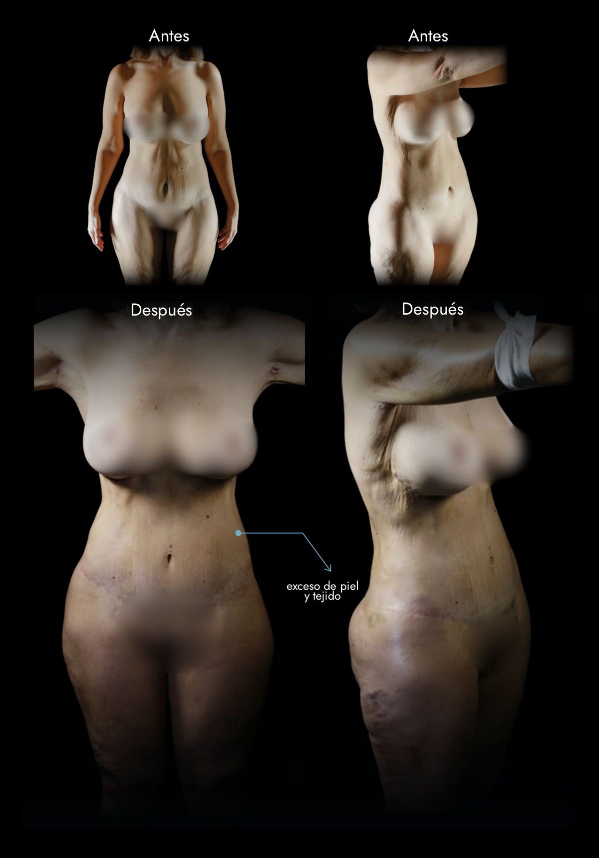 Abdominoplastia en Bogotá: abdomen antes y después de la lipectomía con plicatura, caso real del Dr. Daniel Ramos