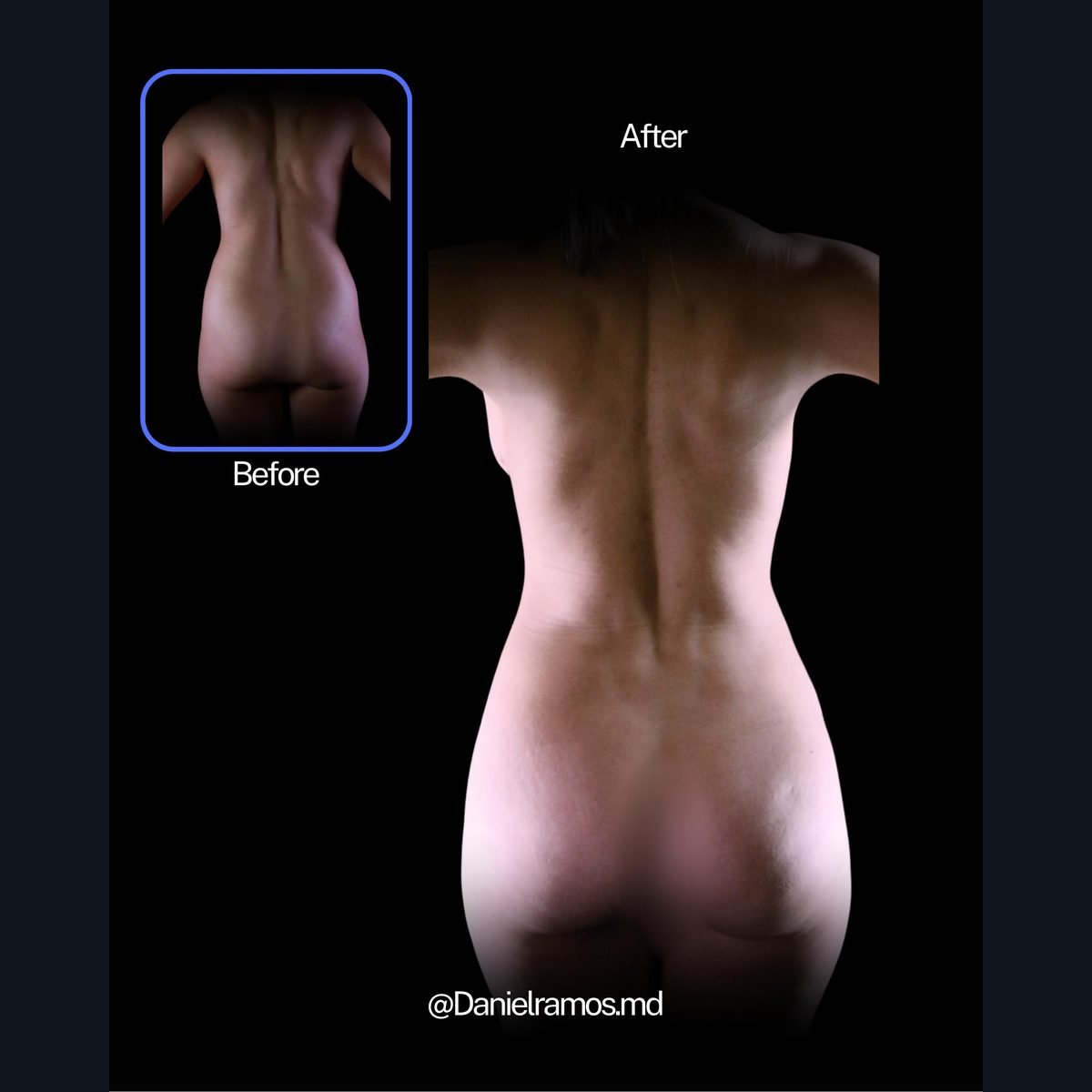 Lipo 360: contorno de espalda y cintura antes y después, Dr. Daniel Ramos, Bogotá