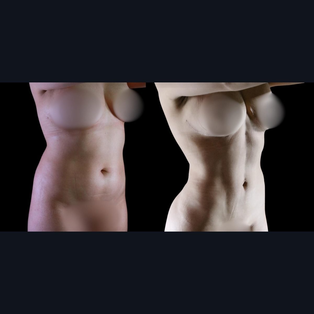 Lipo 360 en Bogotá: abdomen y cintura antes y después de una lipoescultura de alta definición