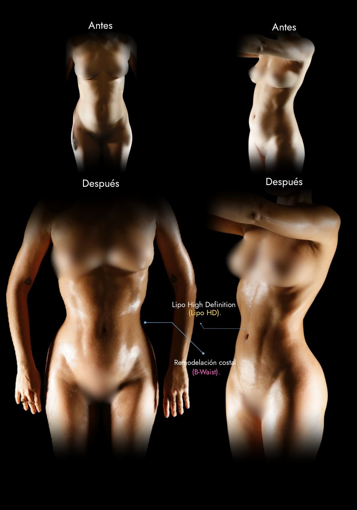Remodelación costal en Bogotá: cintura antes y después de Lipo HD con remodelación costal (B-Waist), caso real del Dr. Daniel Ramos