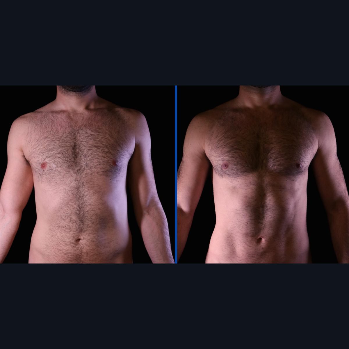 Lipo HD en hombres en Bogotá: abdomen antes y después de una liposucción de alta definición con el Dr. Daniel Ramos
