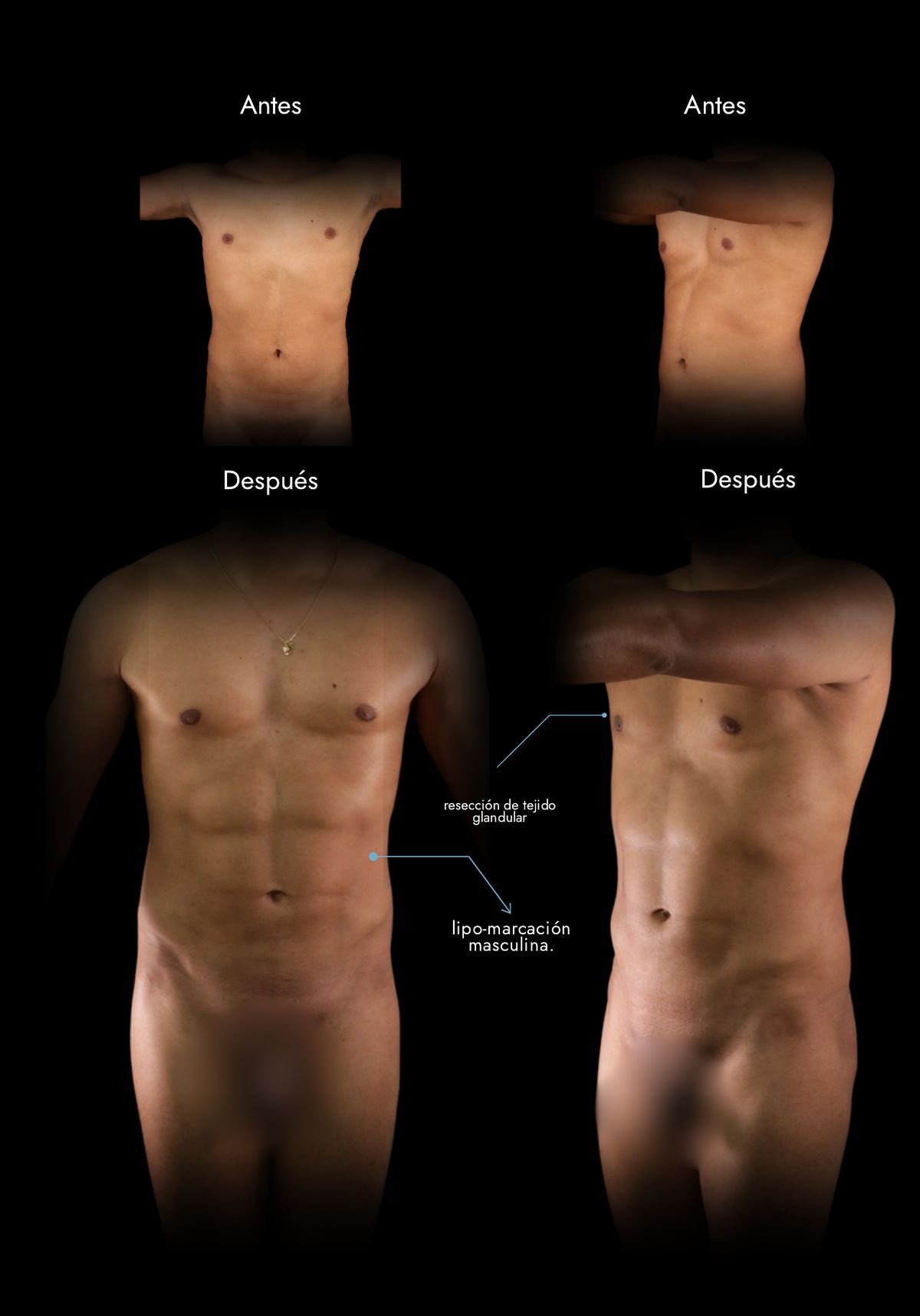 Marcación abdominal masculina de alta definición: antes y después, caso real del Dr. Daniel Ramos, cirujano plástico en Bogotá