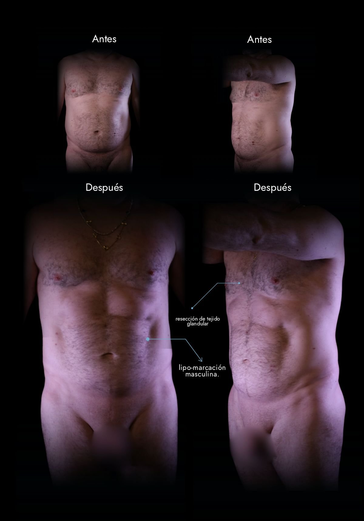 Lipo HD en hombres: abdomen, pecho y cintura antes y después, caso real del Dr. Daniel Ramos, cirujano plástico en Bogotá