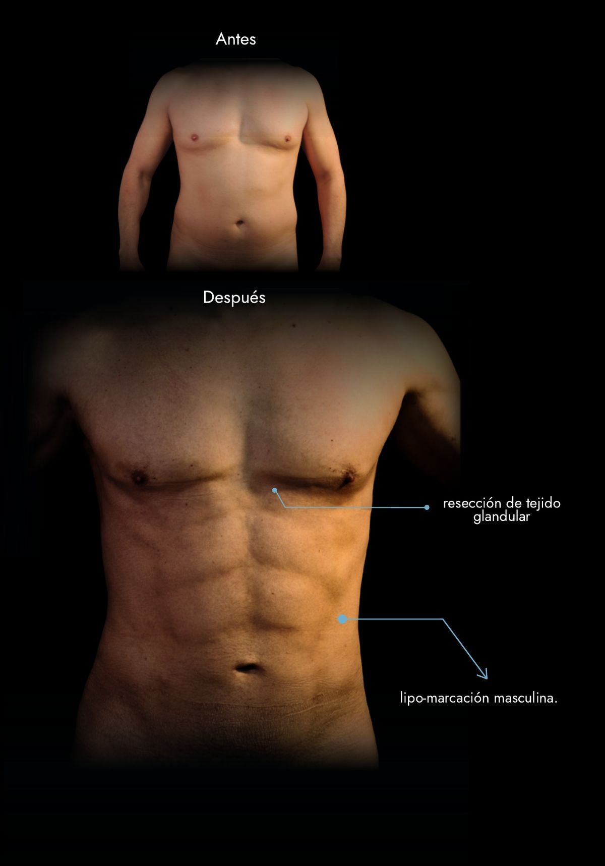 Lipo marcación masculina con resección de tejido glandular (ginecomastia): antes y después, caso real del Dr. Daniel Ramos, cirujano plástico en Bogotá