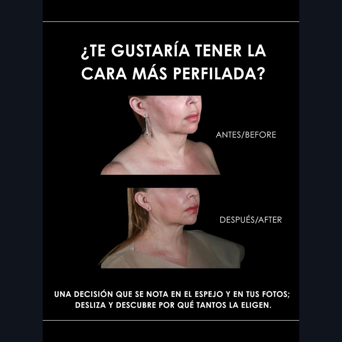 Lipopapada en Bogotá: perfil facial antes y después con el Dr. Daniel Ramos